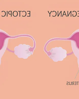 Ectopic Pregnancy